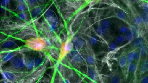 Microdeletion Syndrome